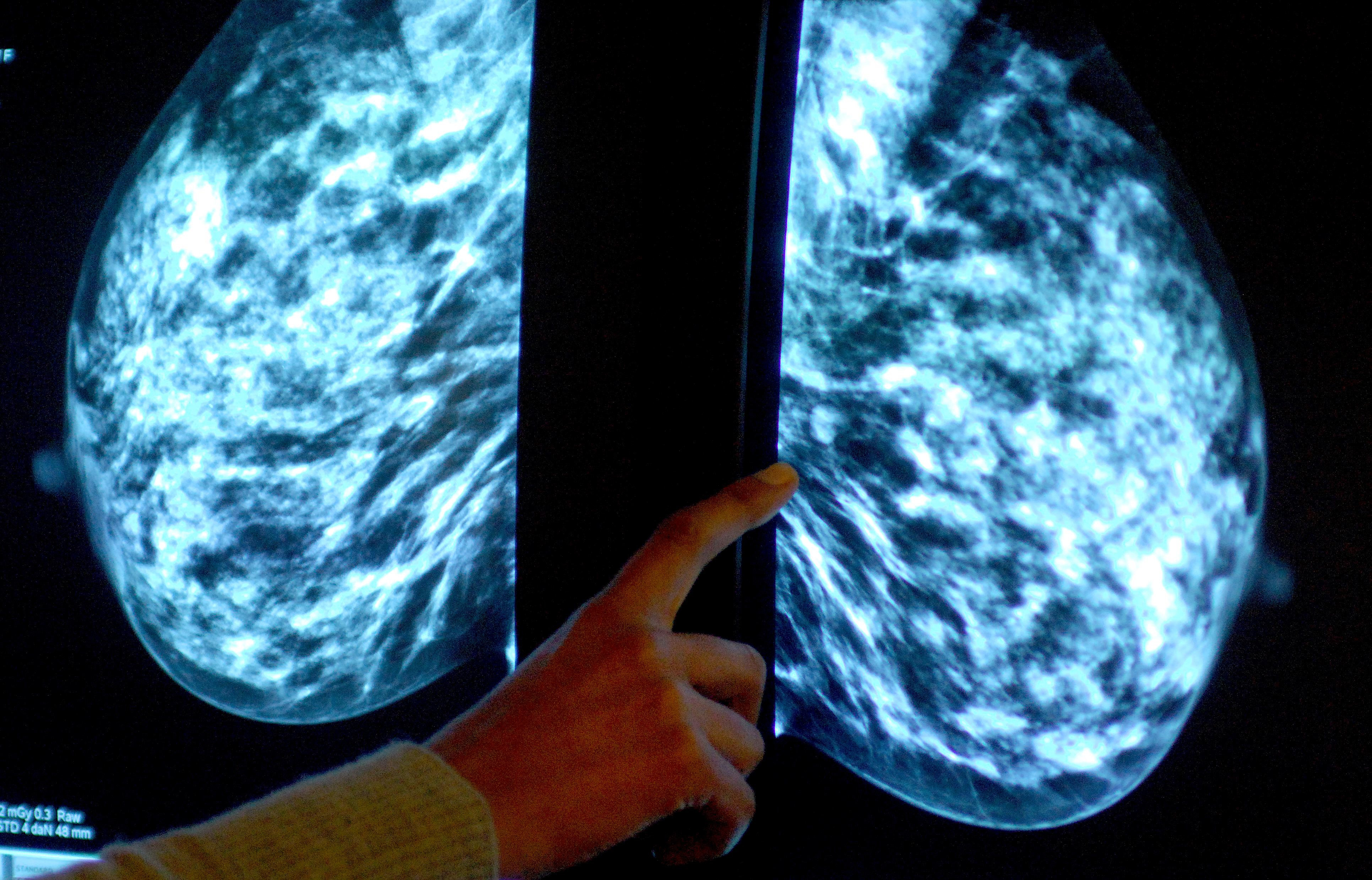 Breast screening uptake in Gloucestershire remains below pre-pandemic levels