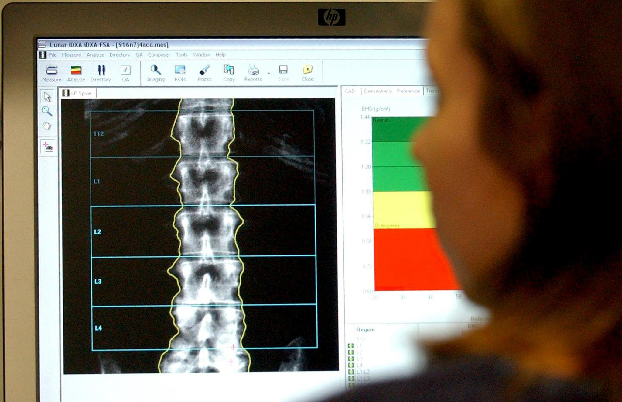 One in six people in Gloucestershire suffer joint, bone and muscle conditions